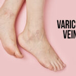 What is the best cure for varicose veins effective and durable