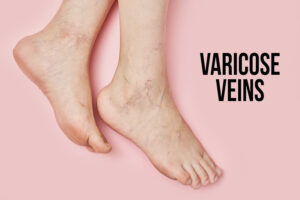 What is the best cure for varicose veins effective and durable