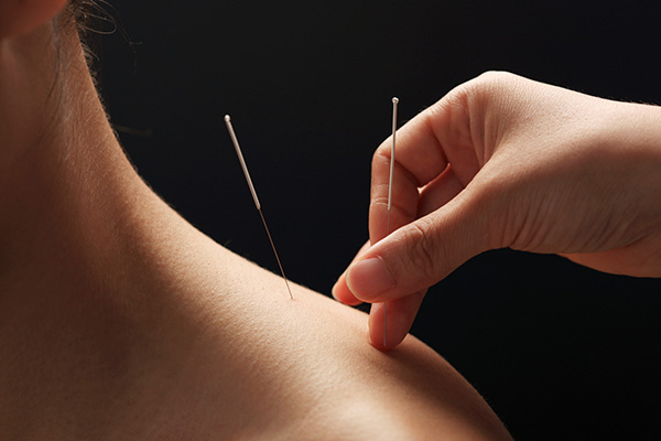 Acupuncture Nanaimo