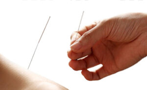 Acupuncture