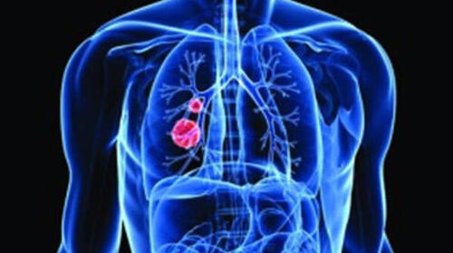 Lungs nodules