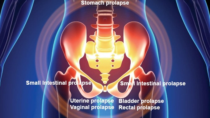 Prolapse