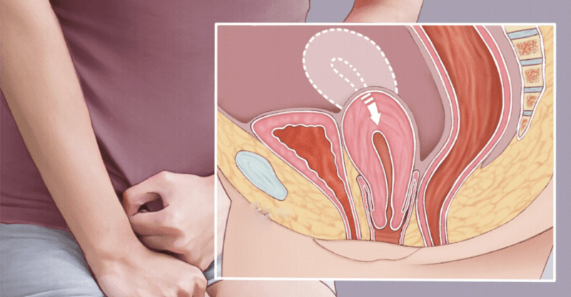 Pelvic organ prolapse-Uterine Prolapse