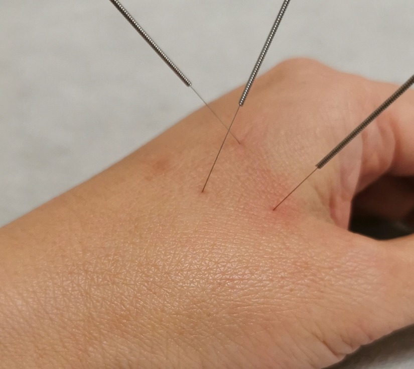 Acupuncture safety Nanaimo