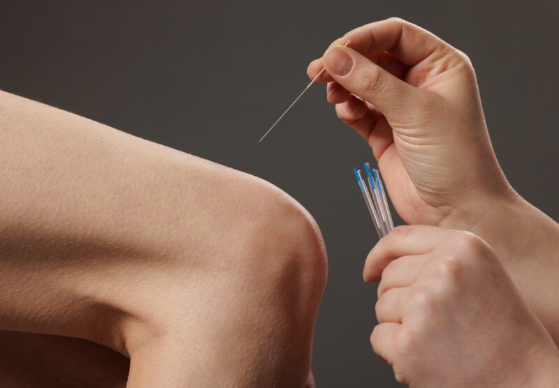 Precision acupuncture treatment for rheumatoid arthritis in Nanaimo.