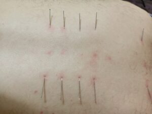 Post-Acupuncture Symptoms: Normal Reactions vs When to Worry