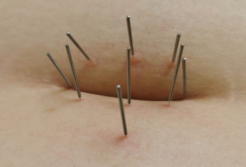 Common-post-acupuncture-symptoms-infographic-energy-changes