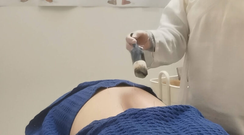 Practitioner applying warming moxibustion to lower back points to strengthen kidney Yang and combat internal coldness.