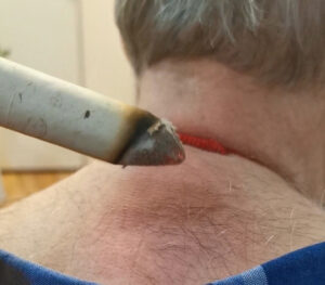 Post-Moxibustion Symptoms-Healing Crisis & Detox Symptoms