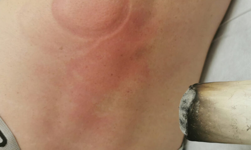 Professional moxibustion therapy in clinical setting - explaining post-moxibustion symptoms.