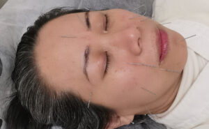 Facial acupuncture